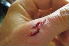 الجرح الخارجي الجرح الخارجي